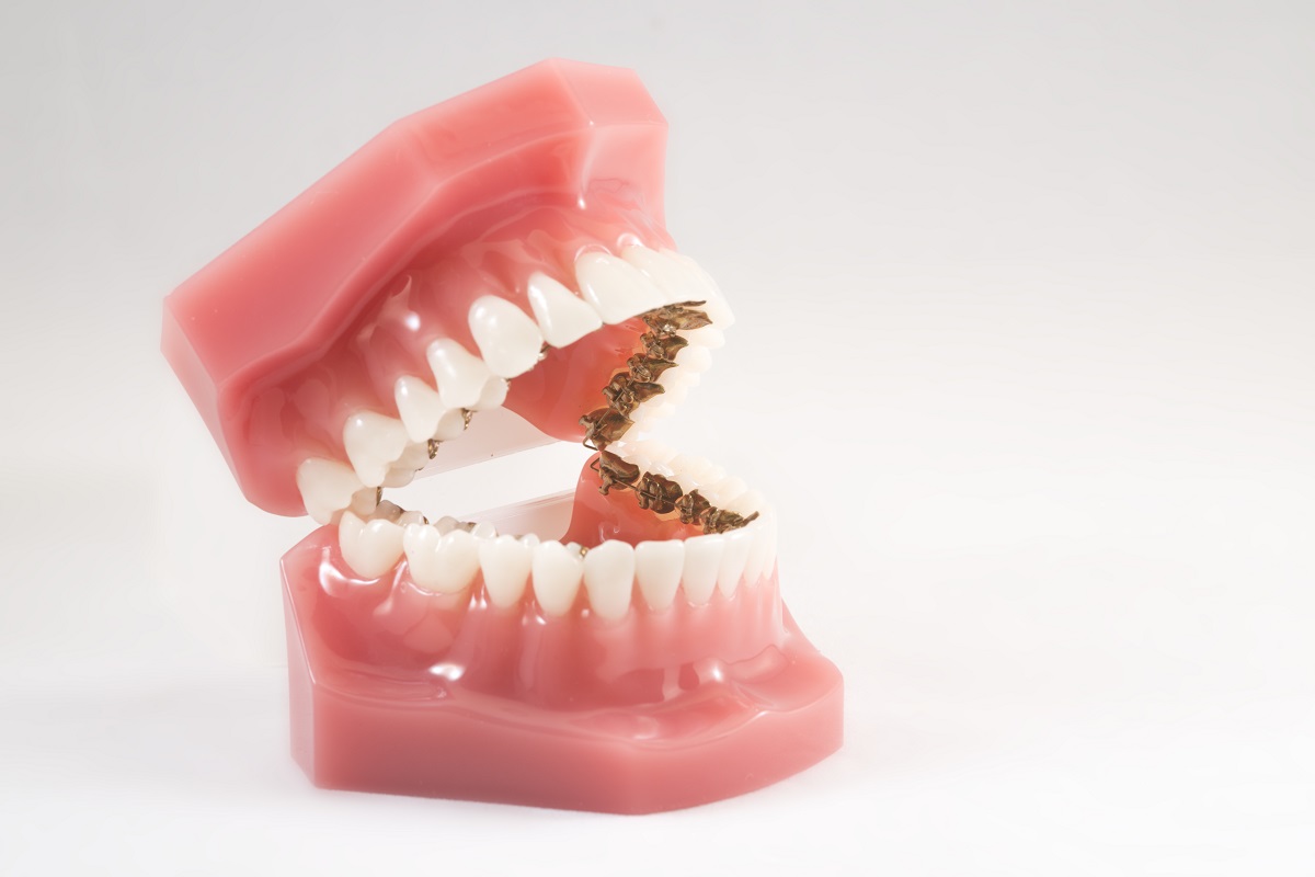 teeth model with braces