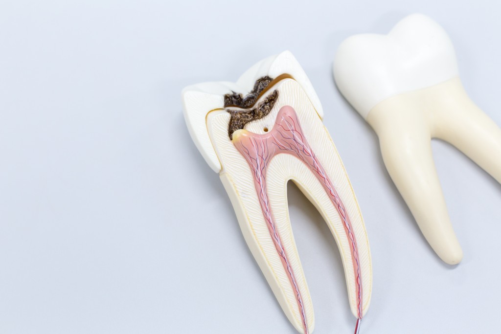 tooth decay model