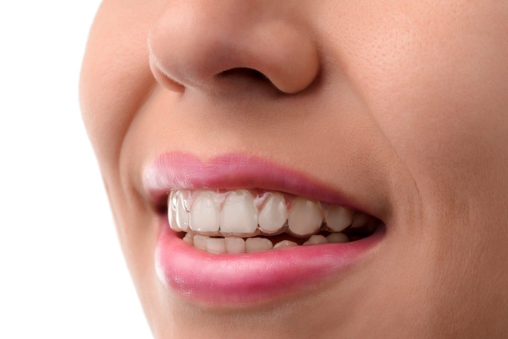 person wearing an invisalign
