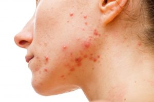 a person with acne