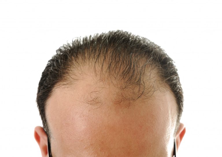 hair loss