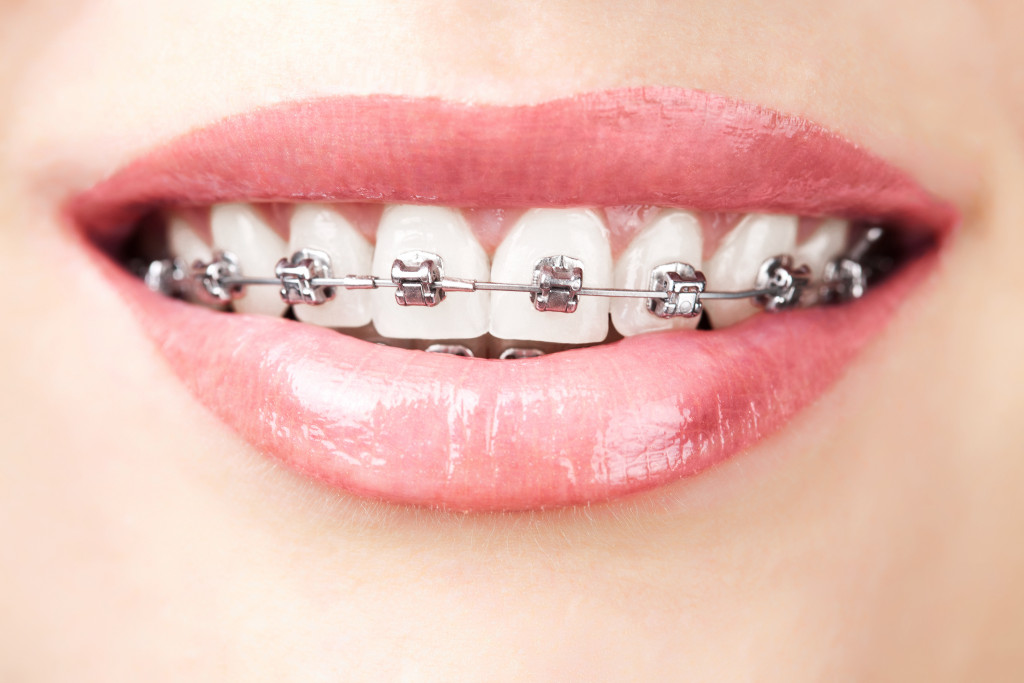 Closeup of teeth with braces