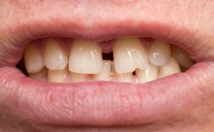 teeth gap and overbite